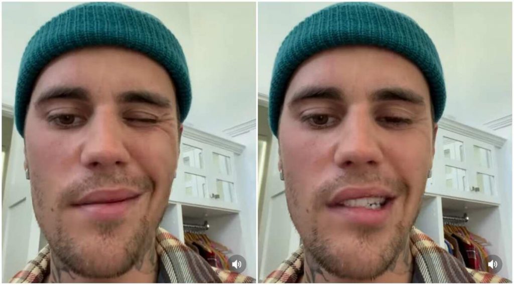 Justin Bieber face paralyzed