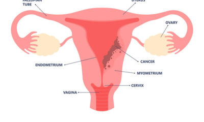 Endometrial Cancer Testosterone Therapy