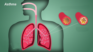 'IDIOT' syndrome hampers asthma treatment: experts