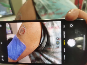 Researchers develop wearable device that measures levels of disease
 markers via 'sweat'