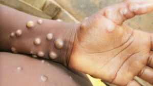 Africa CDC calls for urgent action against concerning spread of mpox